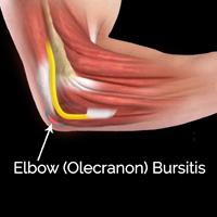 Elbow (Olecranon) Bursitis