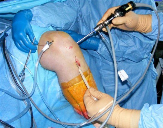 Graft being passed across knee joint
