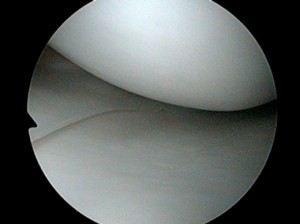 Normal meniscus and articular cartilage
