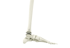 Ankle Joint Replacement