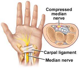 Carpal tunnel surgery releases pressure on median nerve.