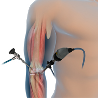 Elbow Arthroscopy