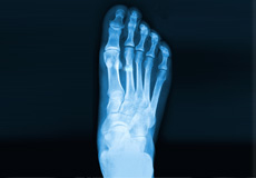 Foot Fracture