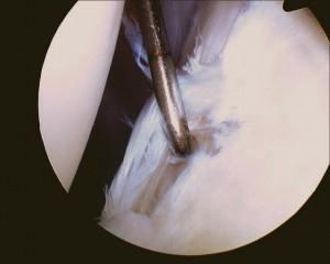 Labral tear