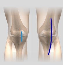 Minimally Invasive Knee Joint Replacement