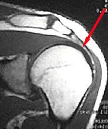 MRI – normal Rotator Cuff