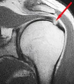 MRI – Rotator Cuff tear