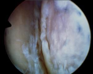 Osteoarthritis (DJD) of shoulder