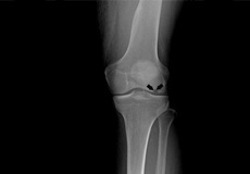 Osteonecrosis of the Knee