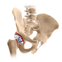 Revision Hip Replacement