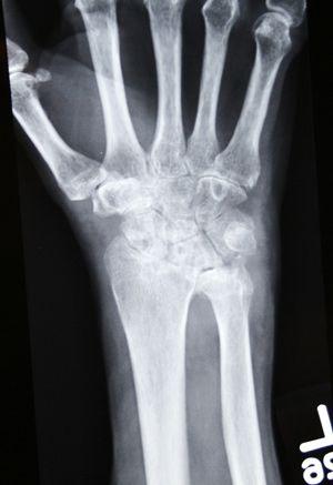 Severe rheumatoid arthritis of the wrist