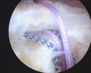 Sutures placed in tendon
