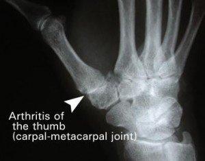 arthritis of the thumb