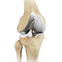 Unicompartmental Knee Replacement