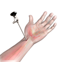 Wrist Arthroscopy